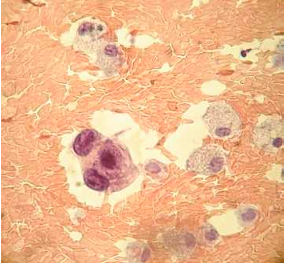 Course Image Curso intensivo del abordaje de los líquidos de punción 2025